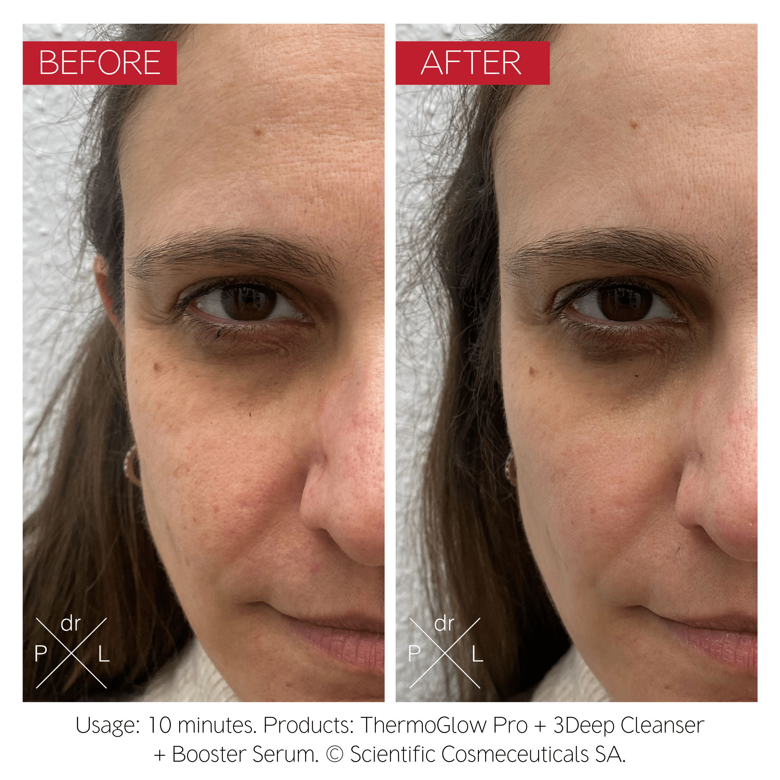 Swiss Luxury Skincare Innovation – ThermoGlow Pro at-Home RF Device