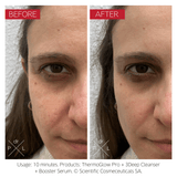 Swiss Luxury Skincare Innovation – ThermoGlow Pro at-Home RF Device