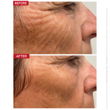 The Contour Pro – EMS and RF device for face sculpting