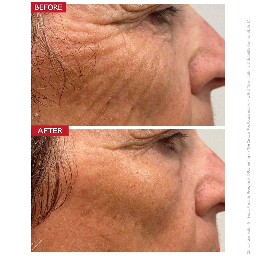 The Contour Pro – EMS and RF device for face sculpting